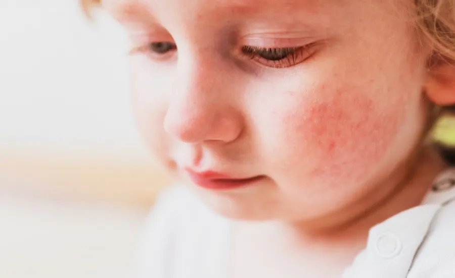 A close-up stock image of a young child with an outbreak of eczema on her cheek.